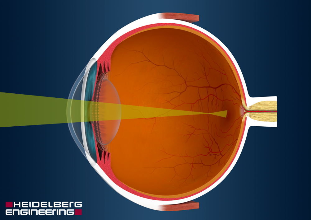 myopia hyperopia and presbyopia)