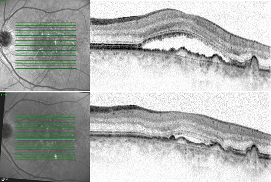 Using OCT to monitor treatment of Wet AMD. Before treatment (top), 4 weeks after initial treatment (bottom)