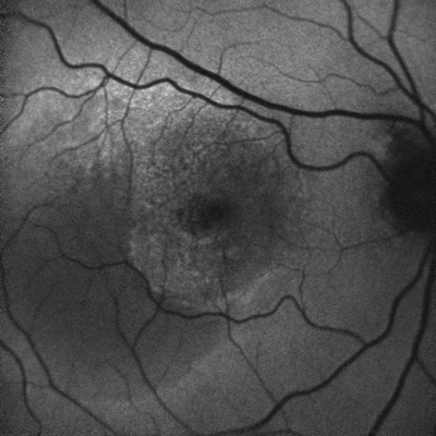 FAF of a patient with AMD