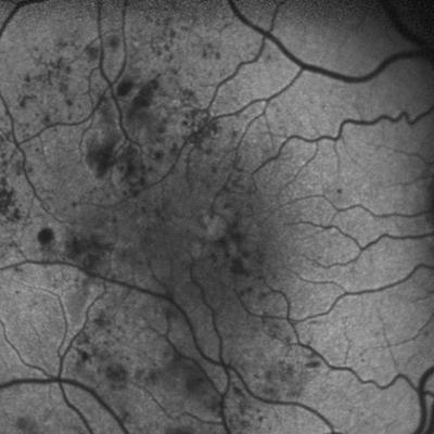 FAF of a patient with diabetic macular edema (DME)