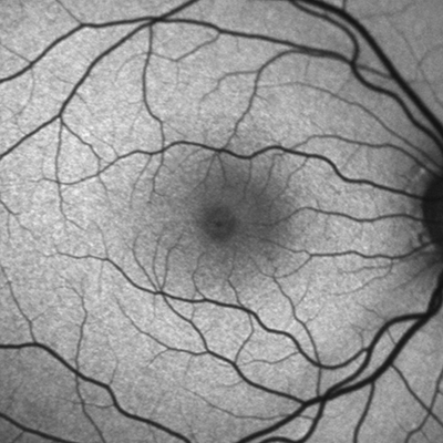 Healthy retina with macular (left) and optic nerve head (right)