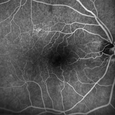 FA of a patient with central serious chorioretinopathy
