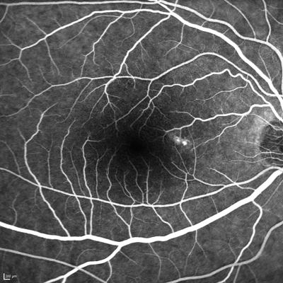 FA of a patient with choroidal neovascularization