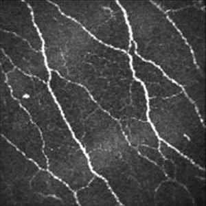Stroma at 62µm